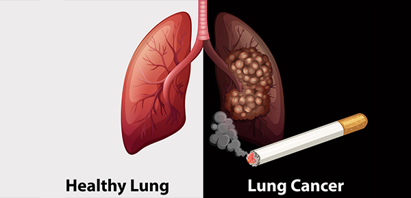 Salah satu pemicu kanker paru-paru adalah