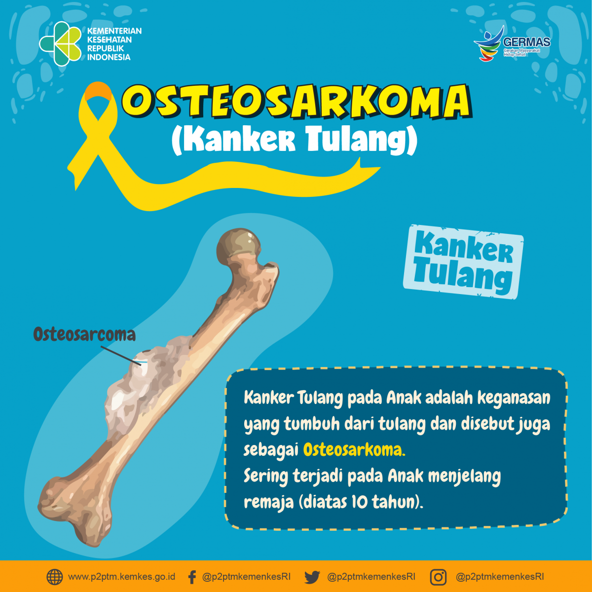 ilustrasi osteosarkoma