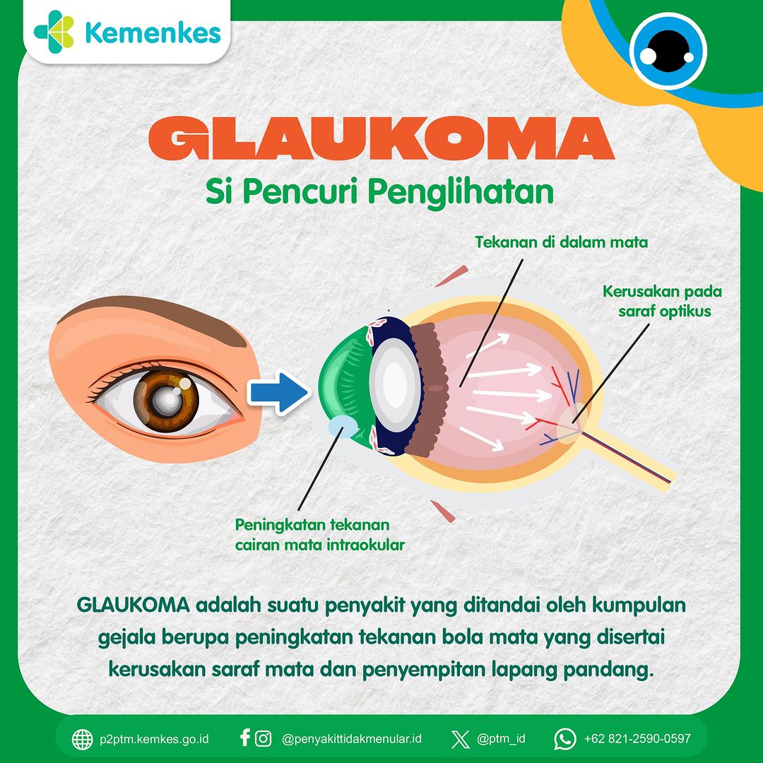 Glaukoma - Si Pencuri Penglihatan