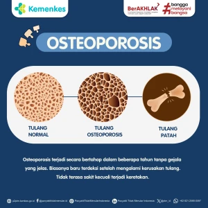 Osteoporosis: Pahami Penyebab dan Cara Pencegahannya!