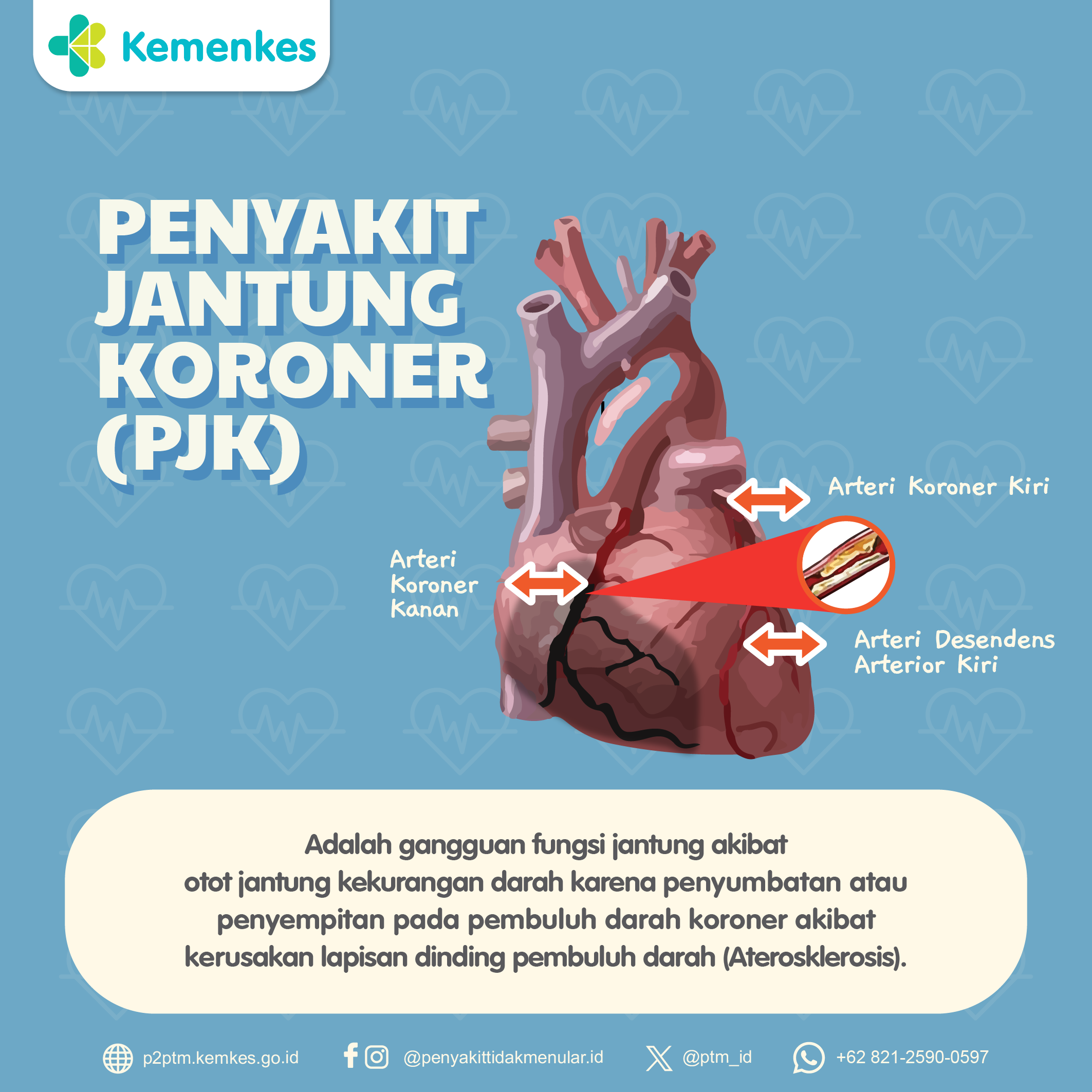 Berikut Adalah Tanda dan Gejala Penyakit Jantung Koroner (PJK)