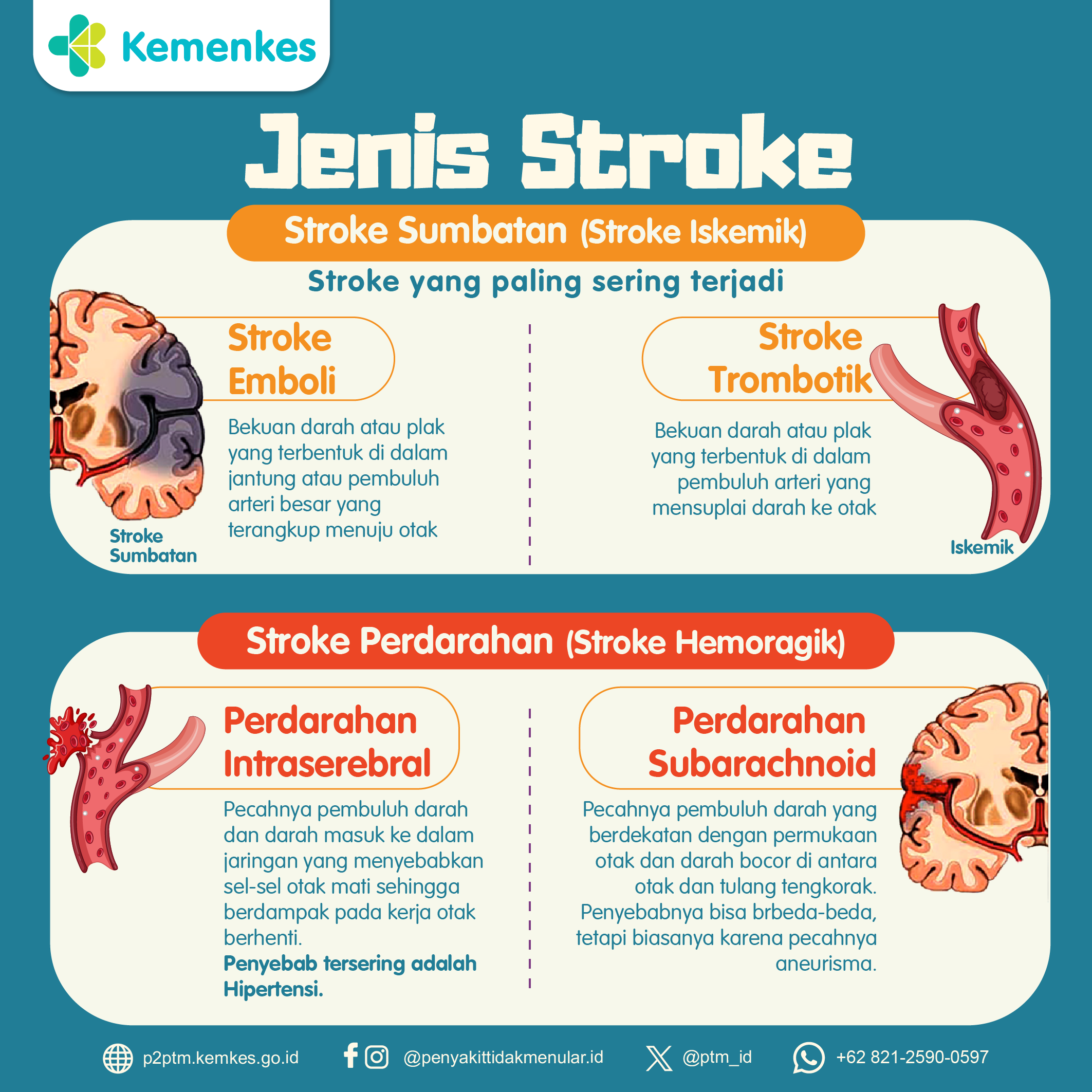 Yuk, Kenali Jenis-Jenis Stroke!