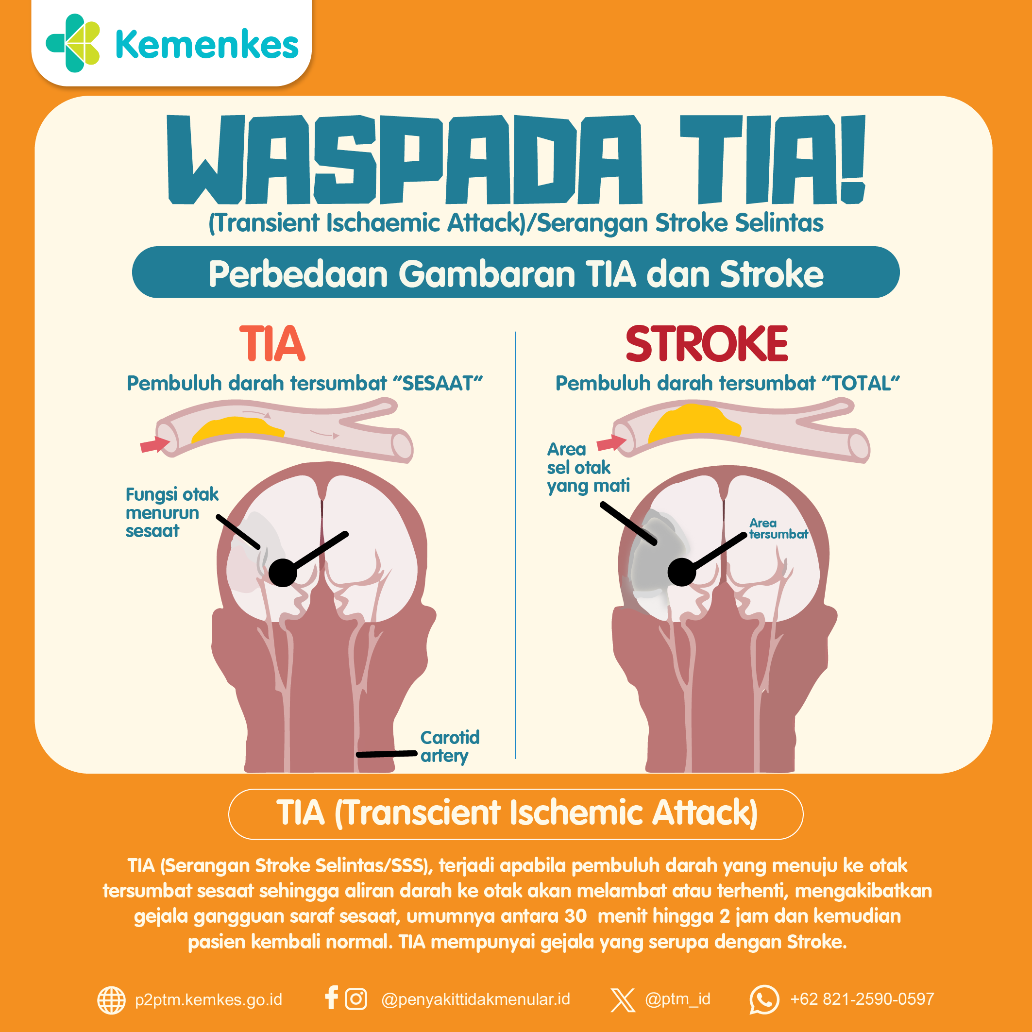 Perbedaan TIA (Transient Ischaemic Attack) dan Stroke