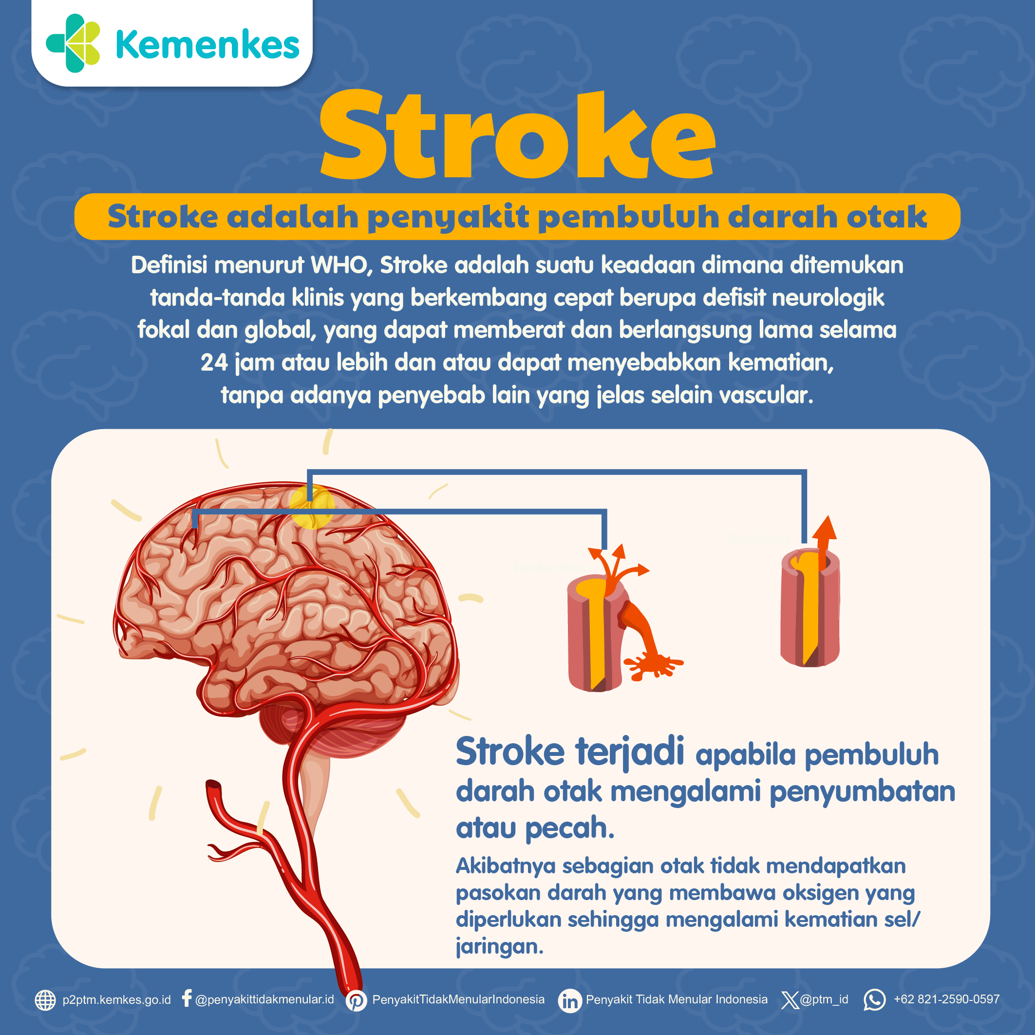 Stroke Adalah Penyakit Pembuluh Darah Otak