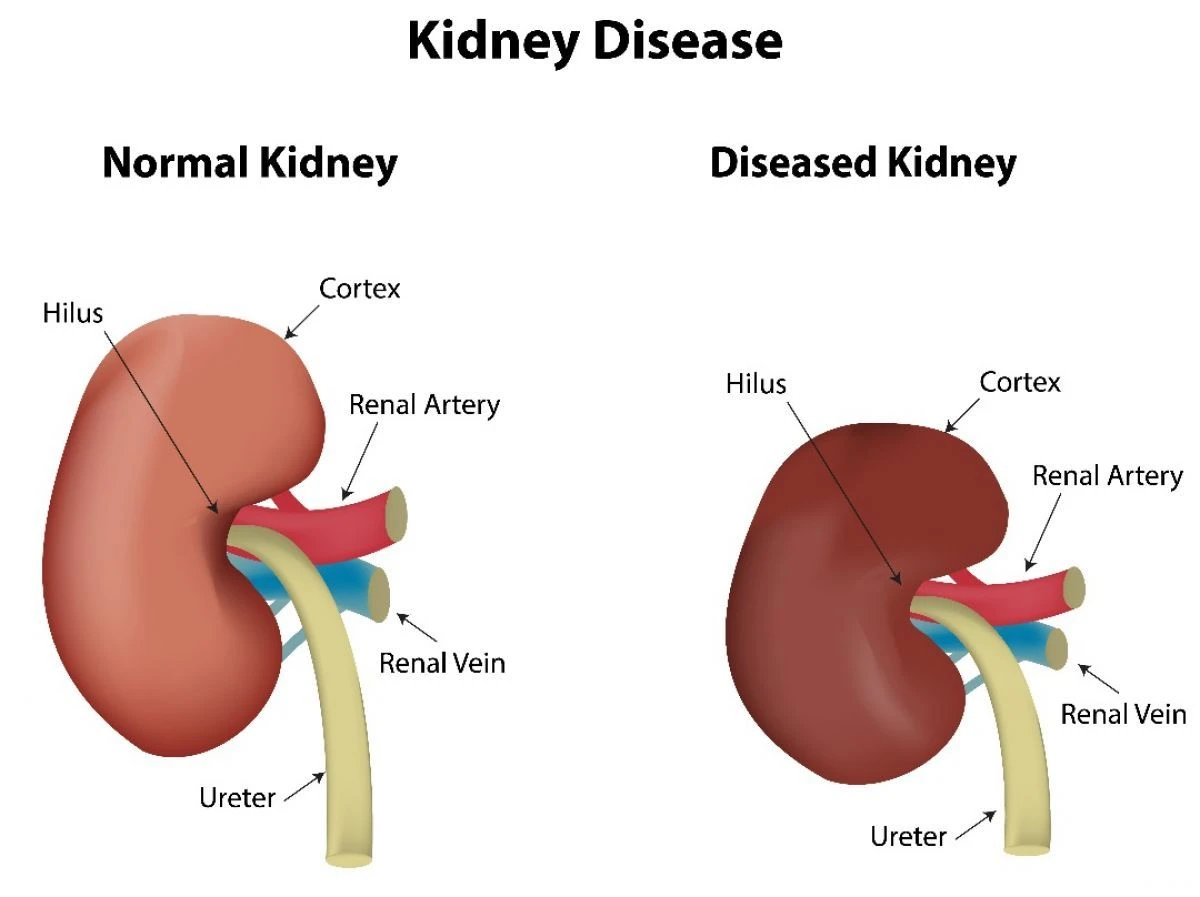 Diagnosis, Klasifikasi, Pencegahan, Terapi Penyakit Ginjal Kronis