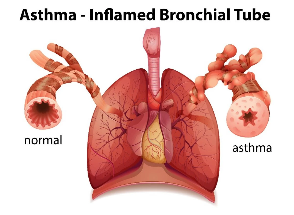 Asma Bronkial (FAQ)