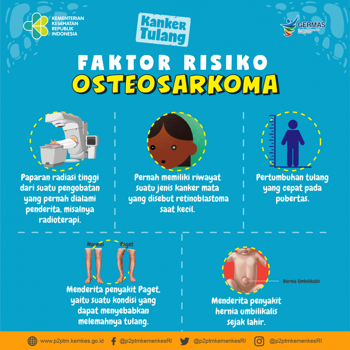 Apa saja faktor risiko Osteosarkoma?