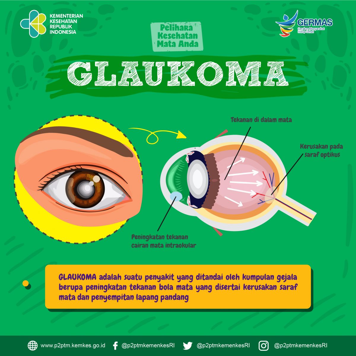 Tahukah Anda, Apa itu Glaukoma ?