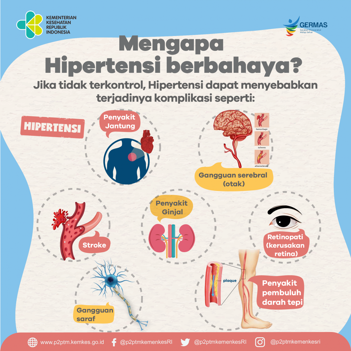 Hipertensi yang tidak terkontrol akan menyebabkan komplikasi