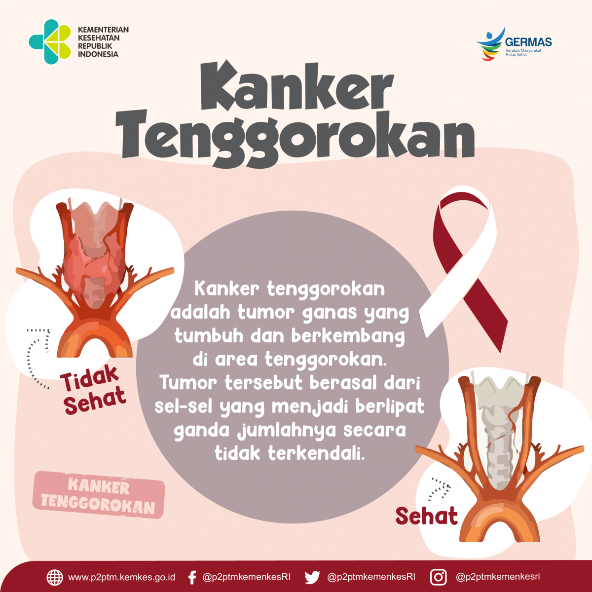 Yuk, kenali apa itu Kanker Tenggorokan