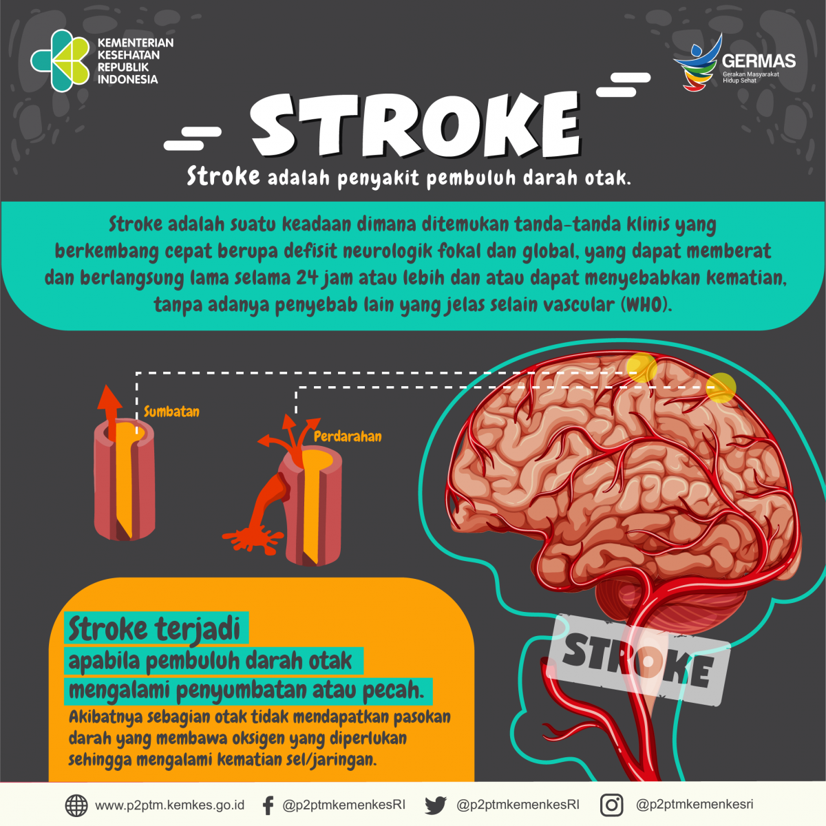 Yuk, mengenal apa itu Stroke?