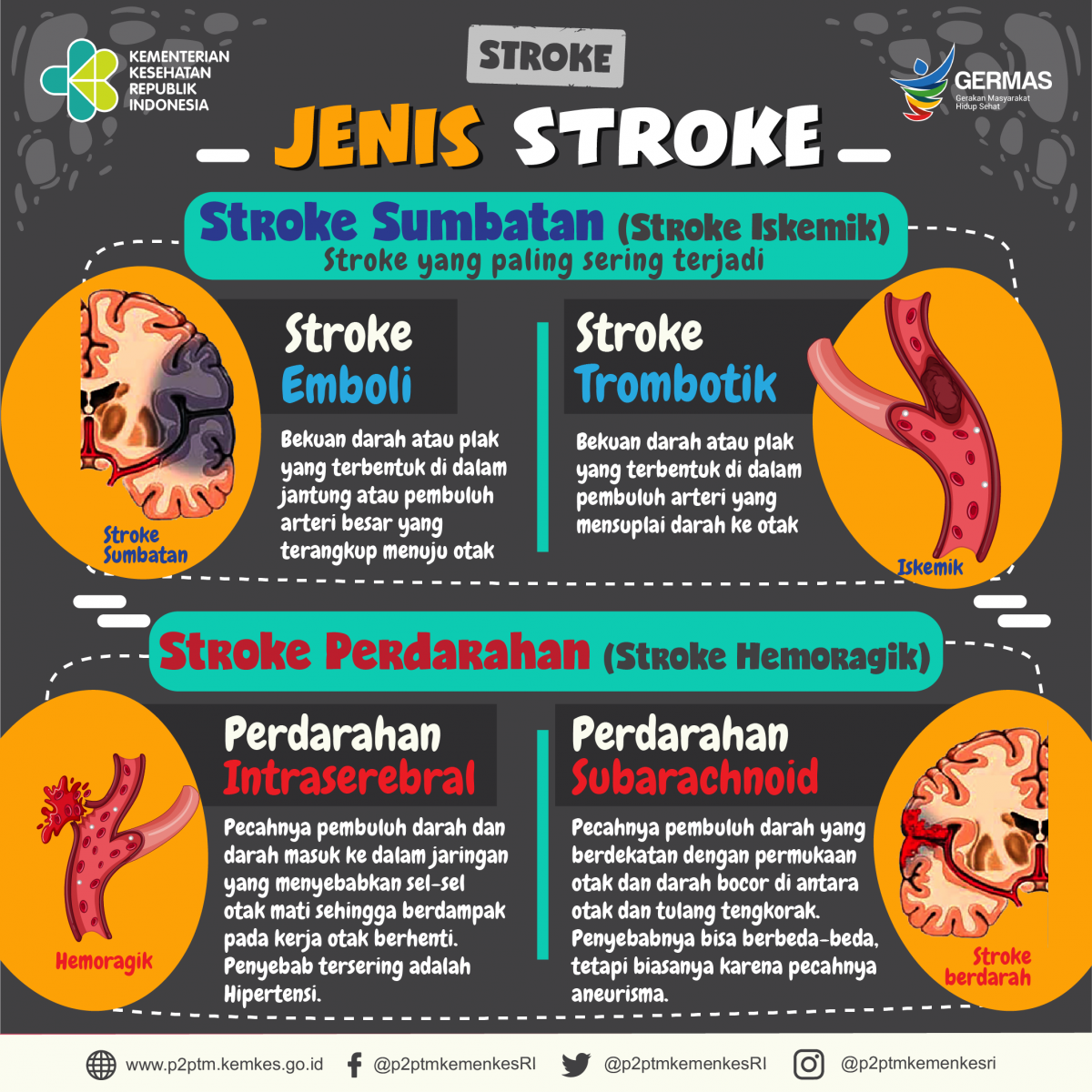 Ketahui jenis-jenis Stroke