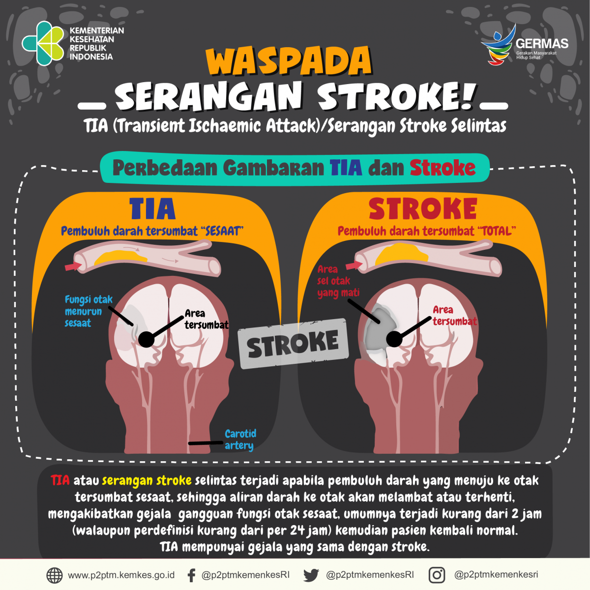 Waspada serangan Stroke!