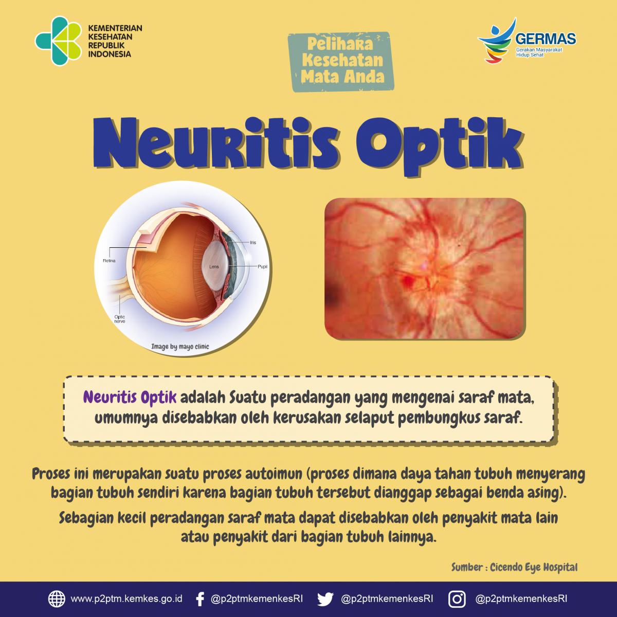 Apa itu Neuritis Optik ?