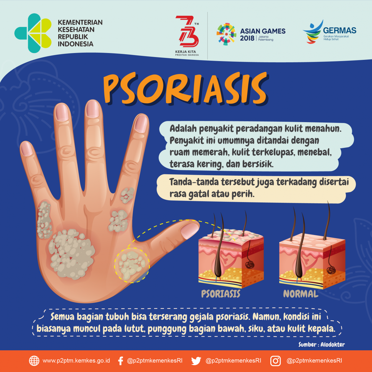 Apa itu Psoriasis?