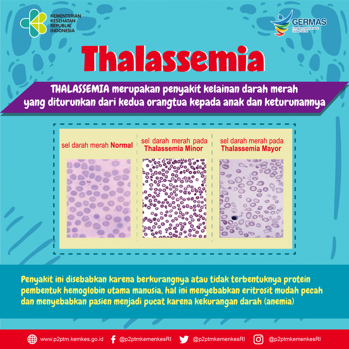 Apa itu Thalassemia ?