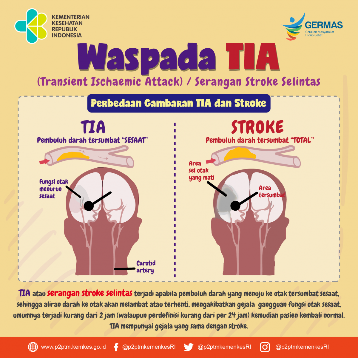 Waspadai TIA ! Setengah dari kasus stroke terjadi setelah mengalami TIA dalam 24 jam pertama