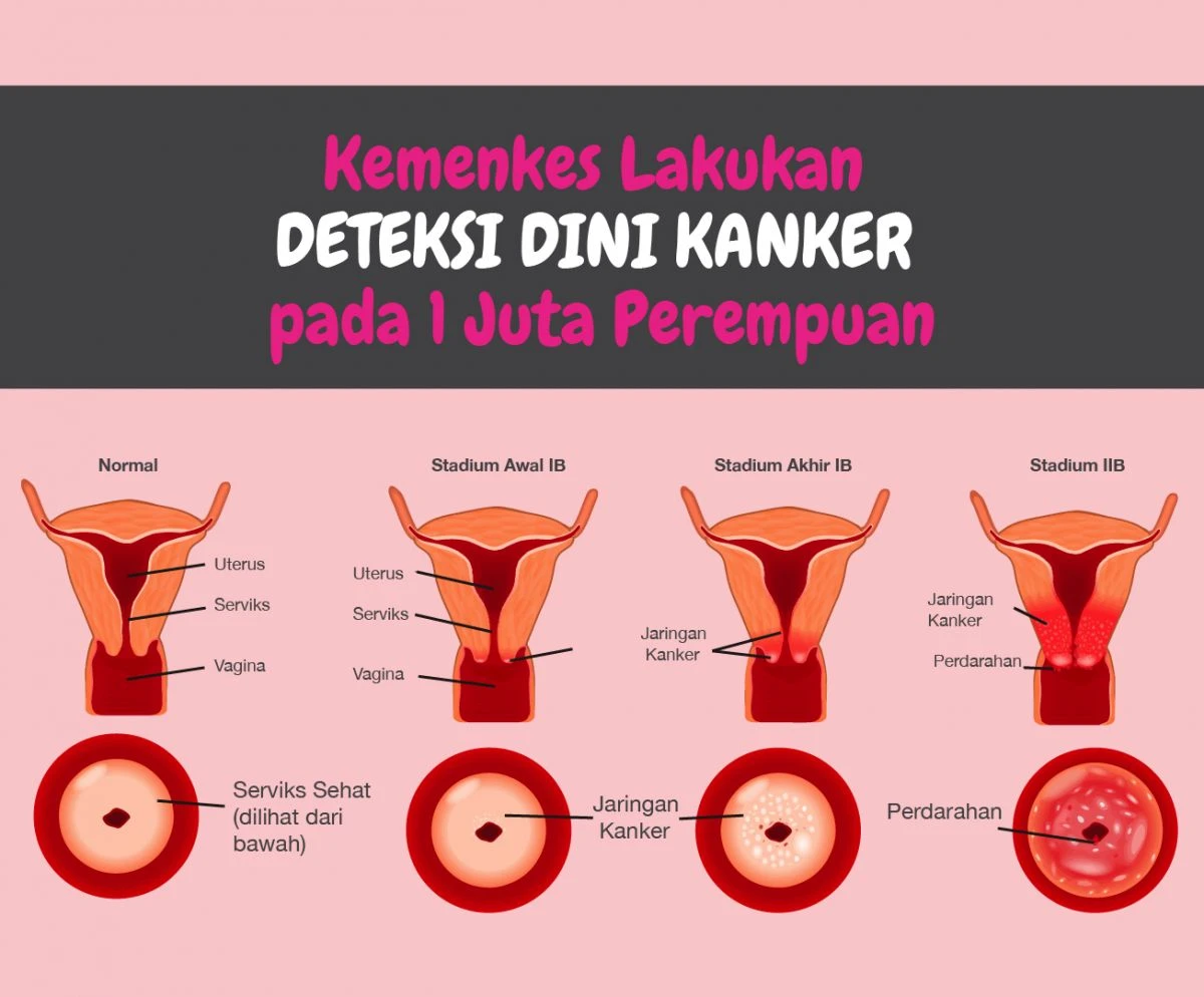 Kemenkes Lakukan Deteksi Dini Kanker pada 1 Juta Perempuan