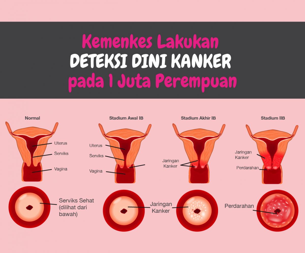 Kemenkes Lakukan Deteksi Dini Kanker pada 1 Juta Perempuan'