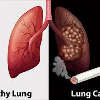 Alasan-Alasan Mereka yang Bukan Perokok Bisa Terkena Kanker Paru-Paru
