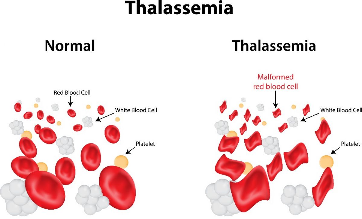 Thalassemia (FAQ) 2'