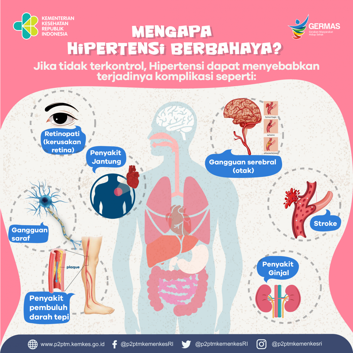 Hipertensi Yang Tidak Terkontrol Dapat Menyebabkan Terjadinya ...